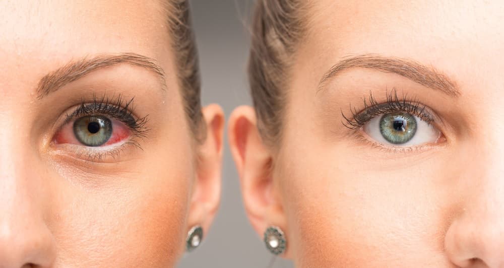 Why do eyes get red when you’re high?