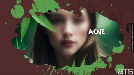 Woman Face acne cannabis